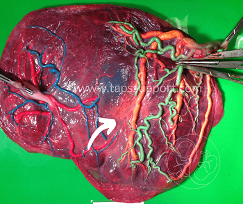 taps placenta dyed acute ttts taps twin anemia polycythemia sequence