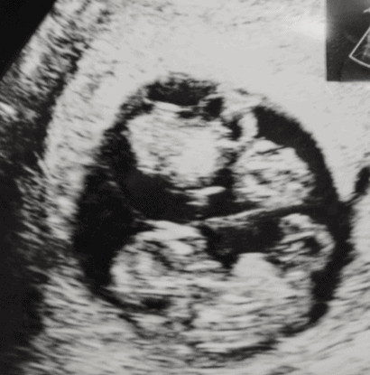 vasa previa in twin ultrasound