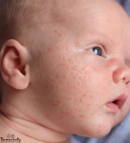 newborn baby with baby acne for baby skin care