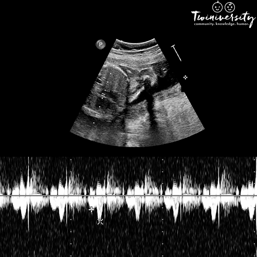 image of a twins' heartbeat in utero