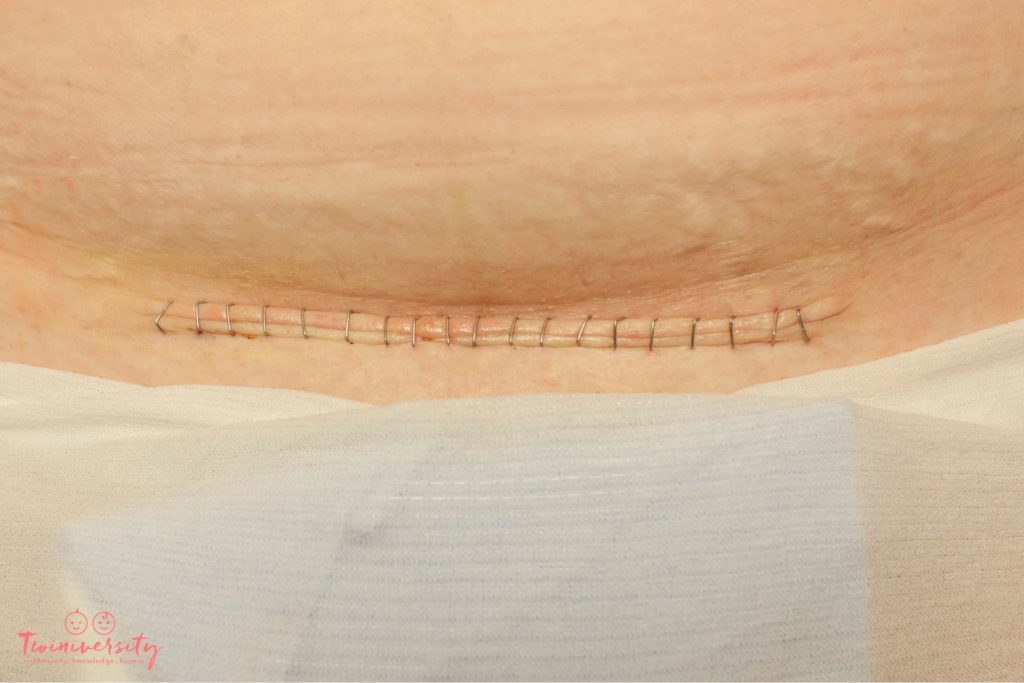 C-section breakdown: showing a c-section scar