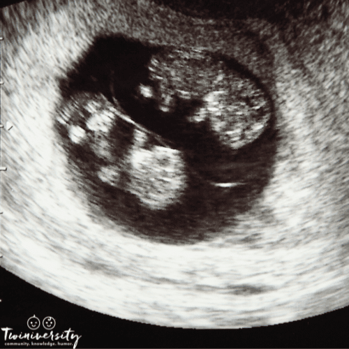 What was Your Reaction to “Having Twins”?