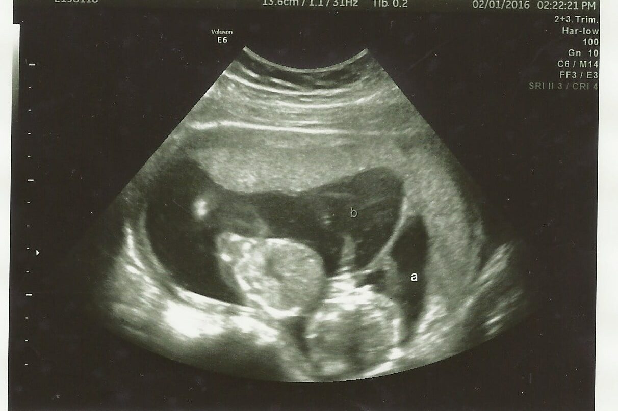 15 weeks pregnant with twins ultrasound