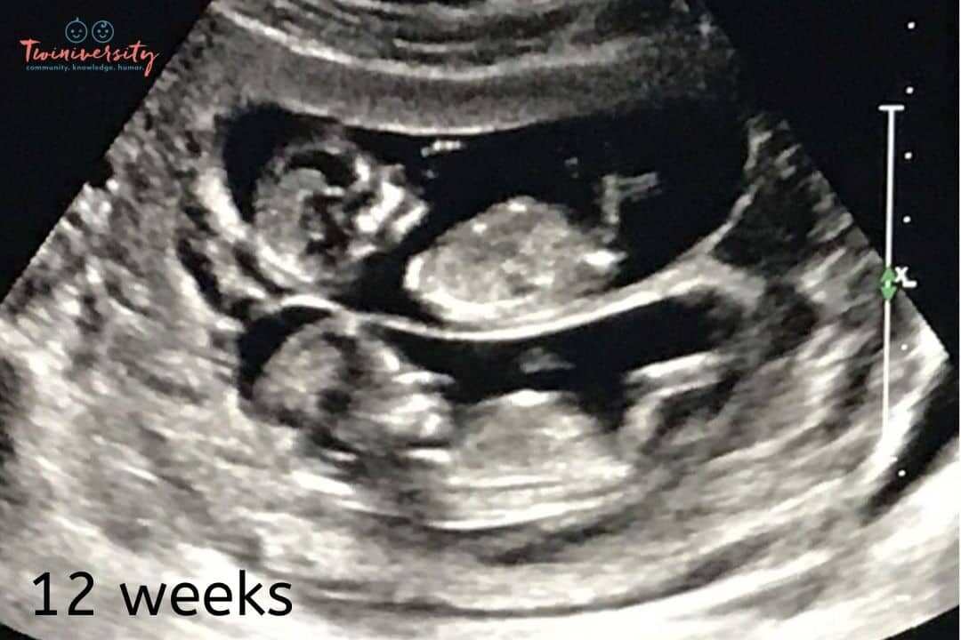 12 week ultrasound of twins