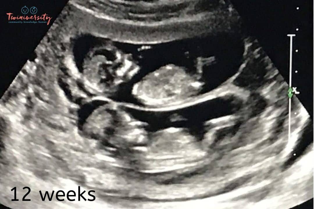 20 Weeks Pregnant With Twins Ultrasound