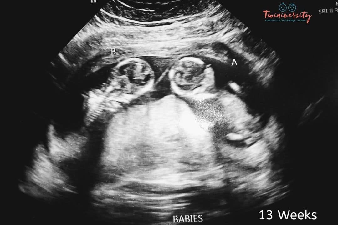 An ultrasound of twins at 13-week gestation.