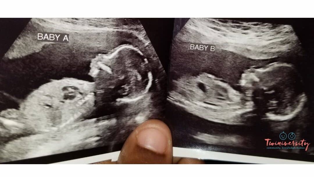 Finding out you are pregnant with twins at a later ultrasound: 20 weeks
