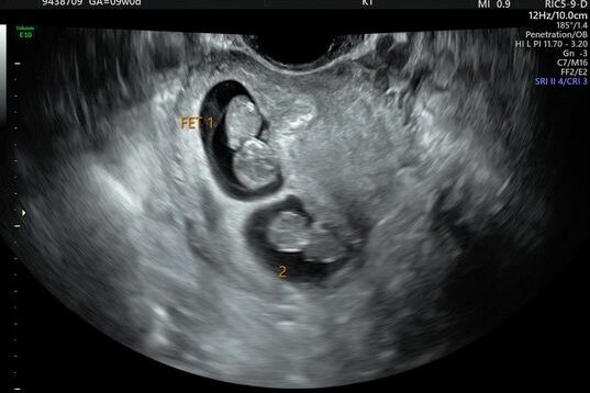 9 week ultrasound picture