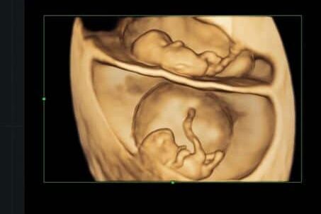 12 week ultrasound picture