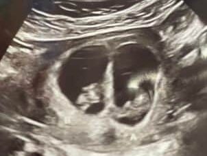 8 week ultrasound with twins