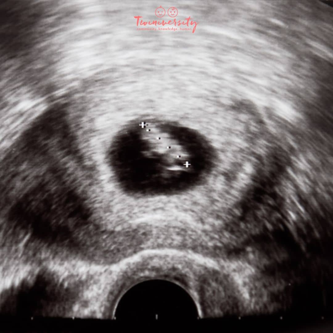 The hCG Levels That Could Mean You're Having Twins | Twiniversity #1