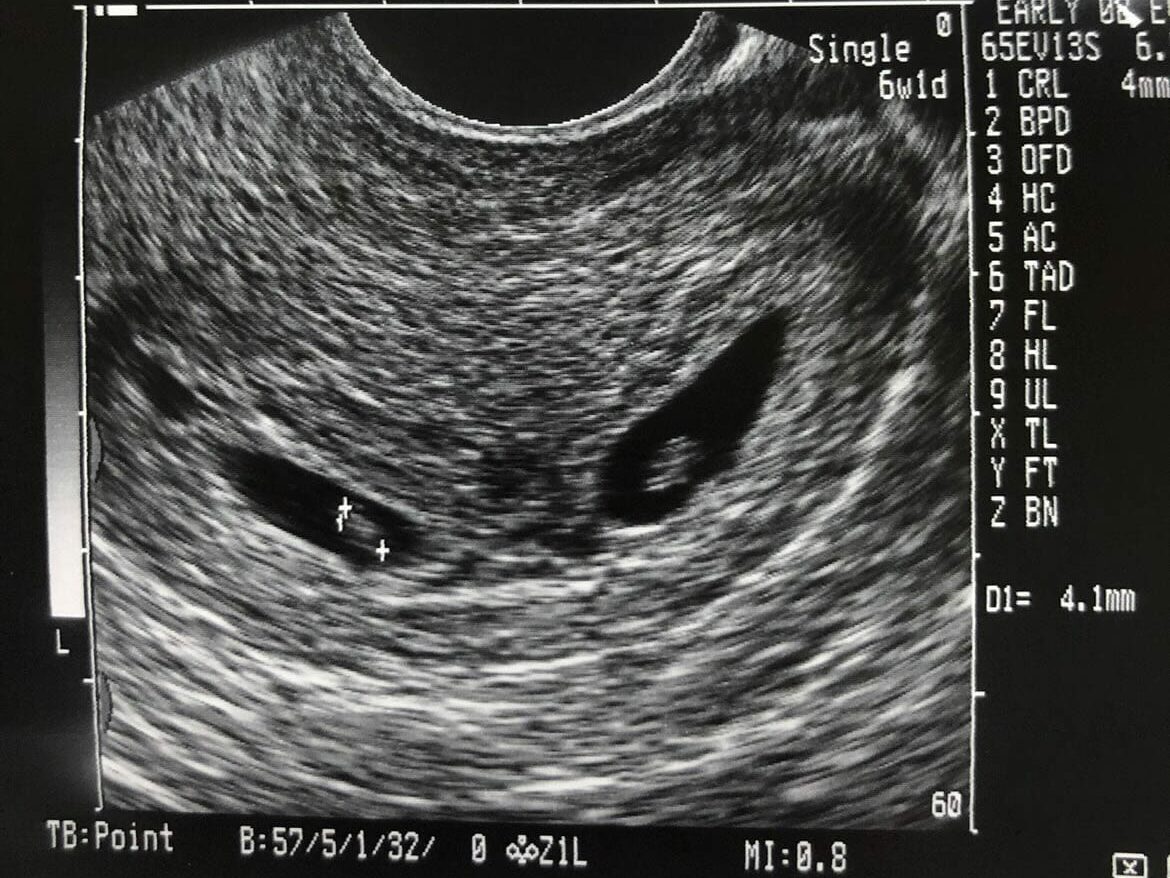 6 week twin ultrasound