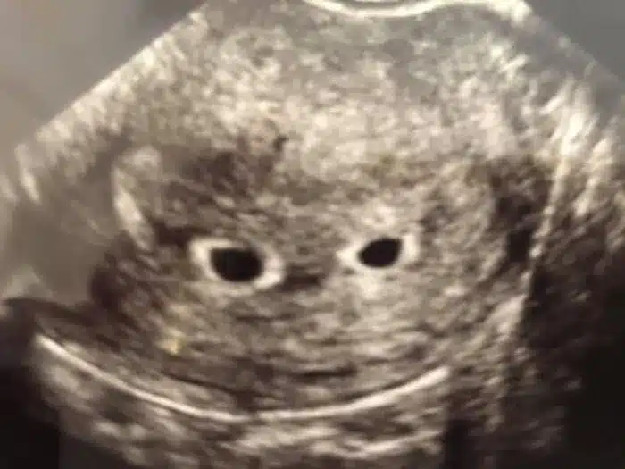 twin ultrasound