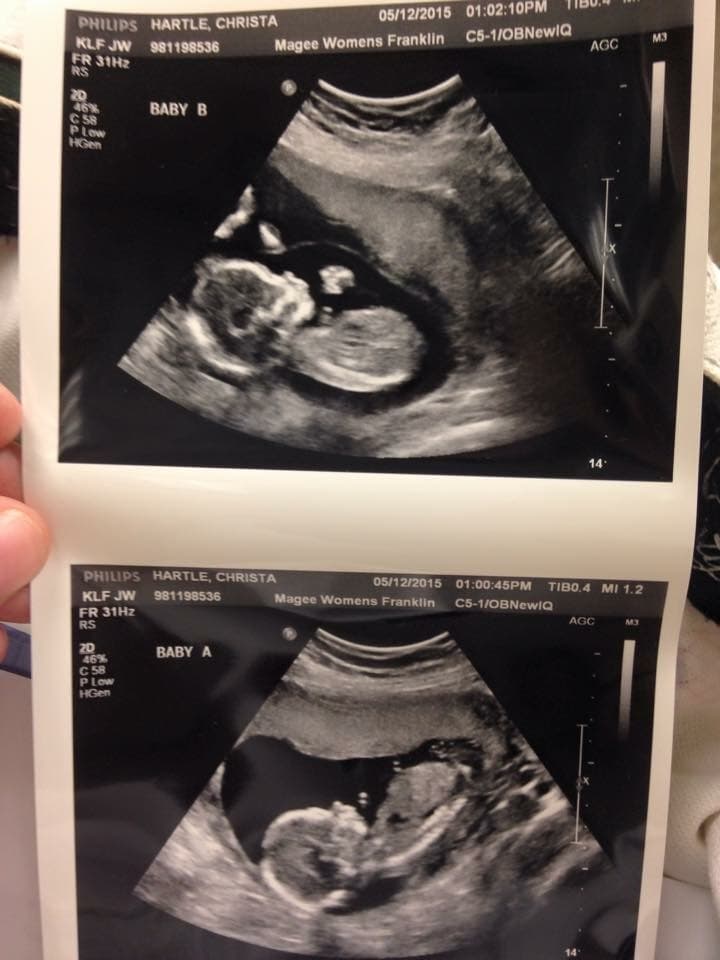 20 weeks pregnant with twins (1)
