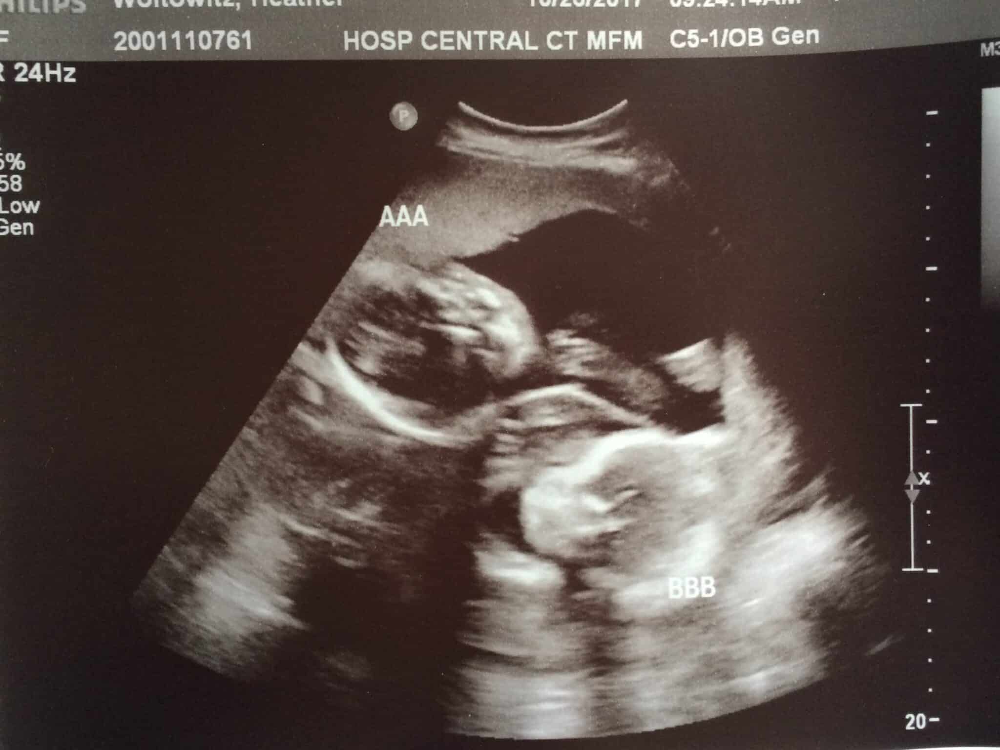 20 weeks pregnant with twins (1)