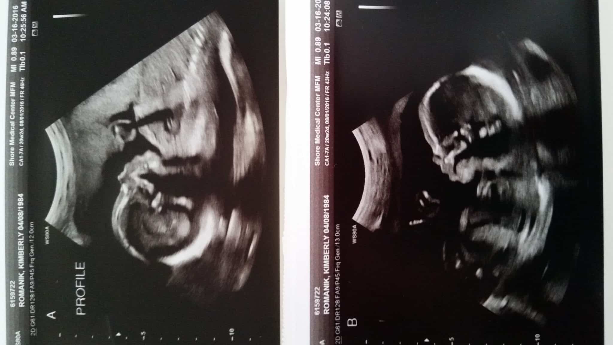 20 weeks pregnant with twins (1)