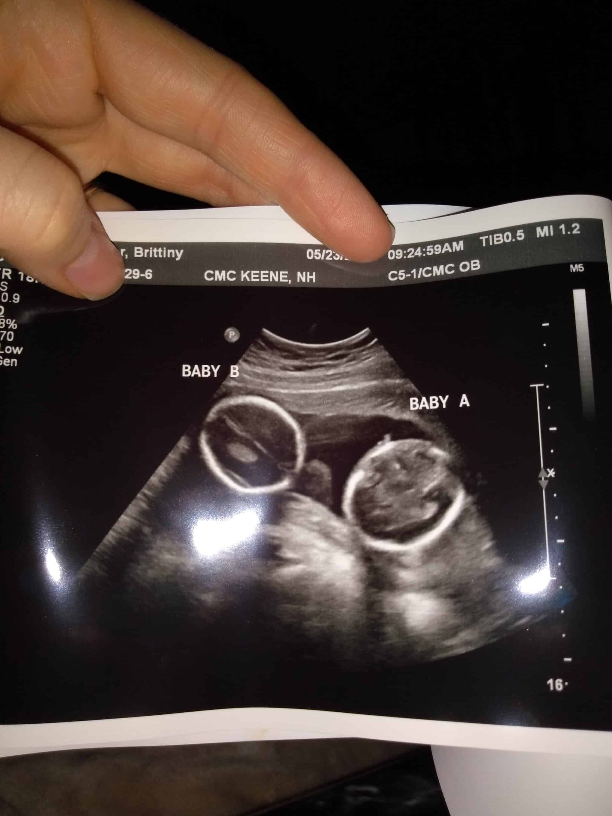 20 Weeks Pregnant with Twins Tips, Advice & How to Prep Twiniversity