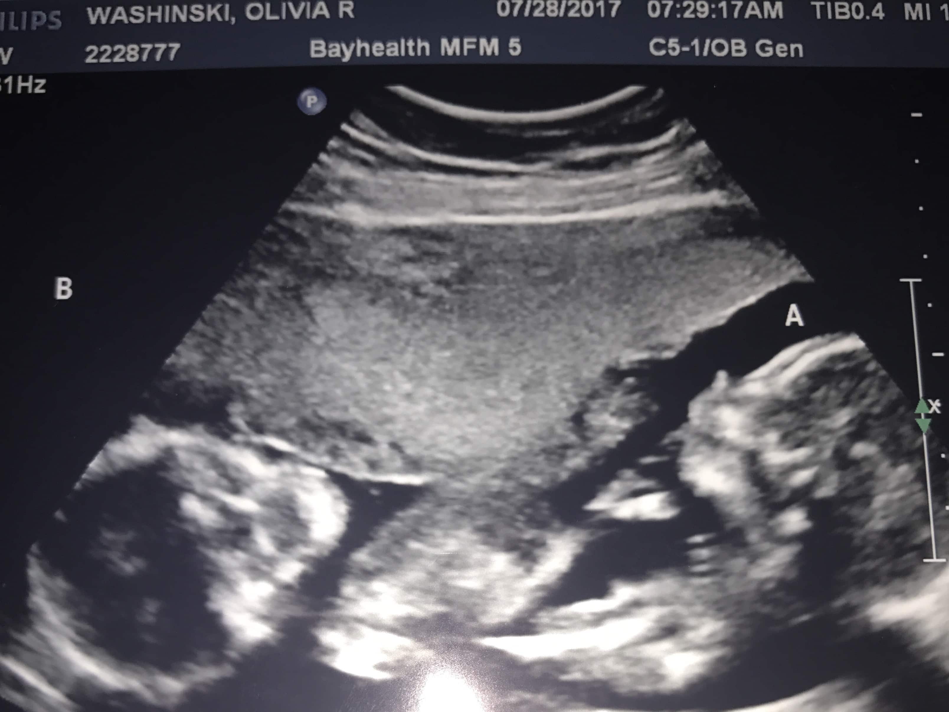 20 Weeks Pregnant With Twins Ultrasound