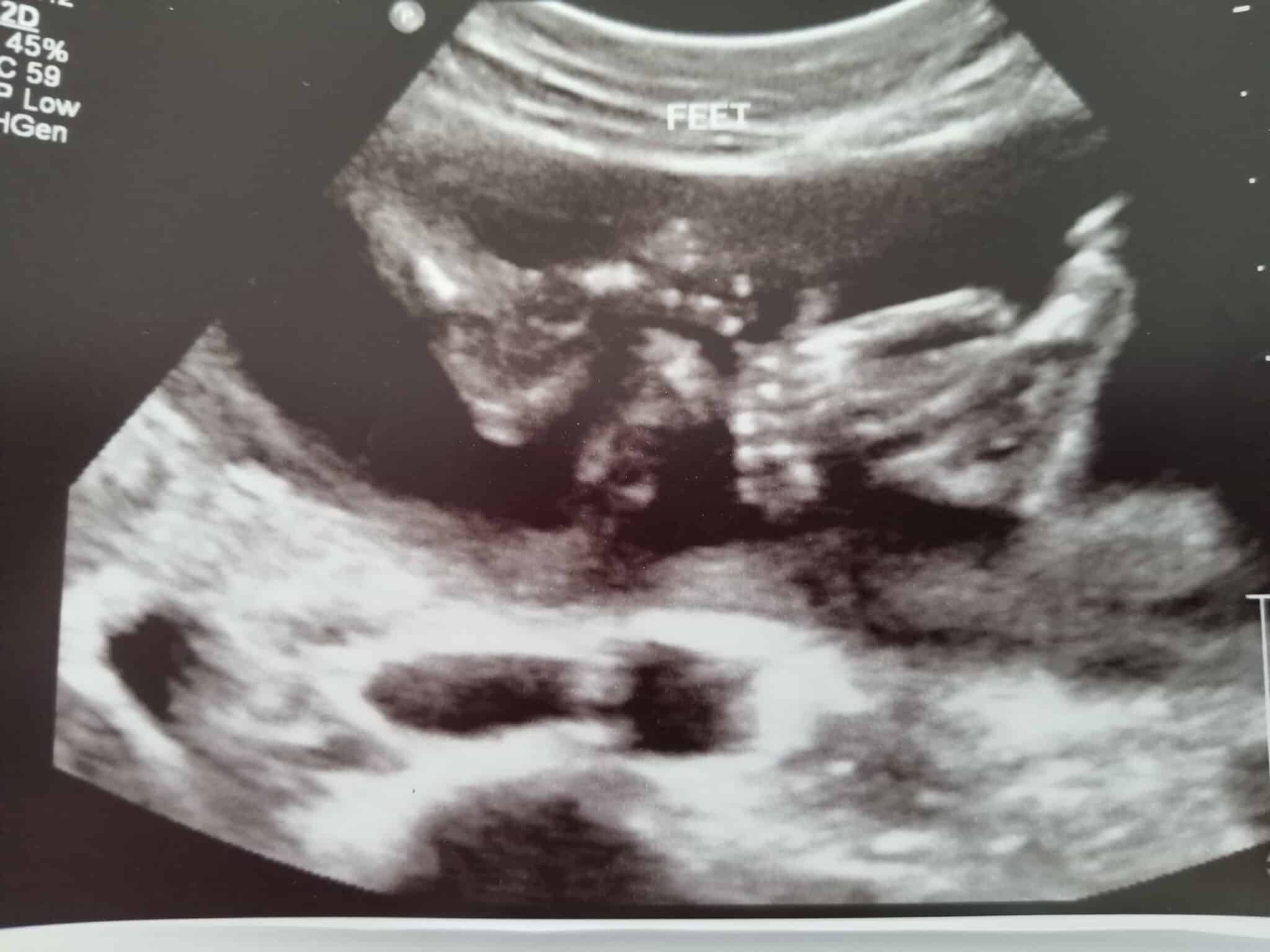 20 weeks pregnant with twins (1)