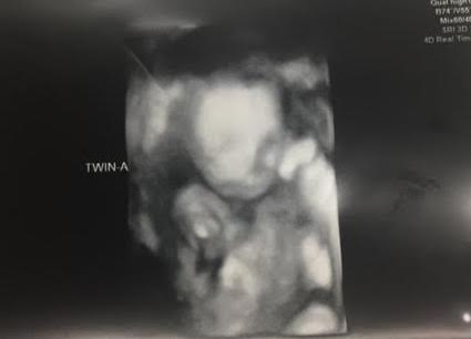 21 weeks pregnant with twins