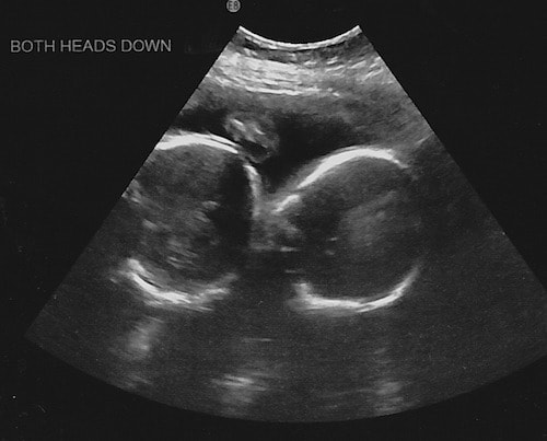 24 weeks pregnant with twins