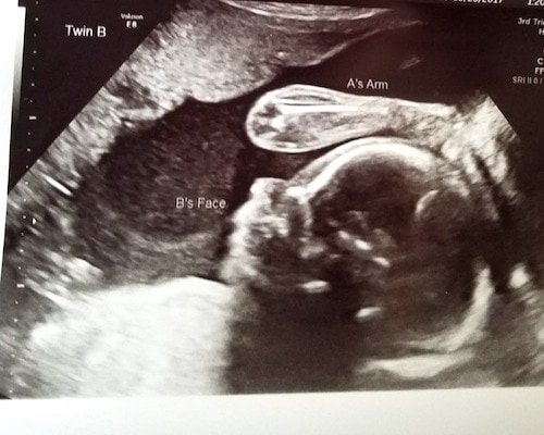 24 Weeks Ultrasound Twiniversity