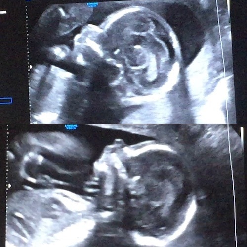 24 Wks 3days Ultrasound Twiniversity