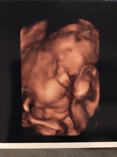 24wks Ultrasound Twiniversity