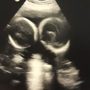 24 weeks twin ultrasound