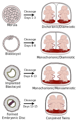 identical twins infographic identical twin pregnancy