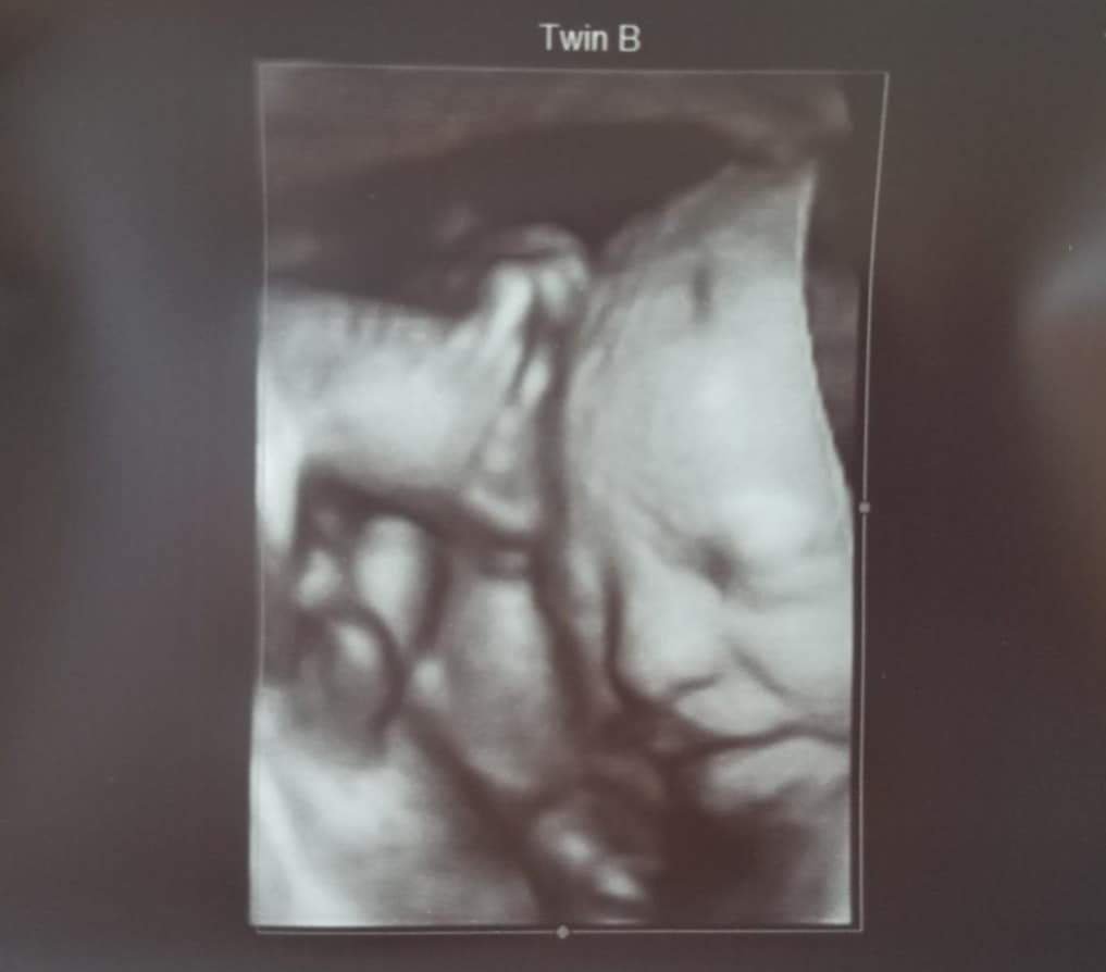 30 weeks pregnant with twins
