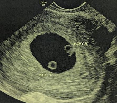 twins at 5 weeks pregnant sonogram