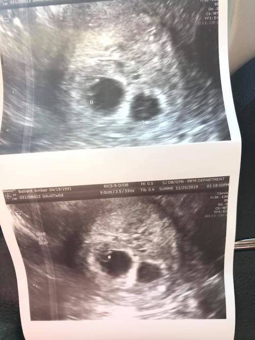 ultrasound at 5 weeks with twins