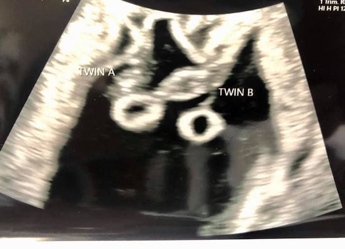 5 Weeks Pregnant with Twins