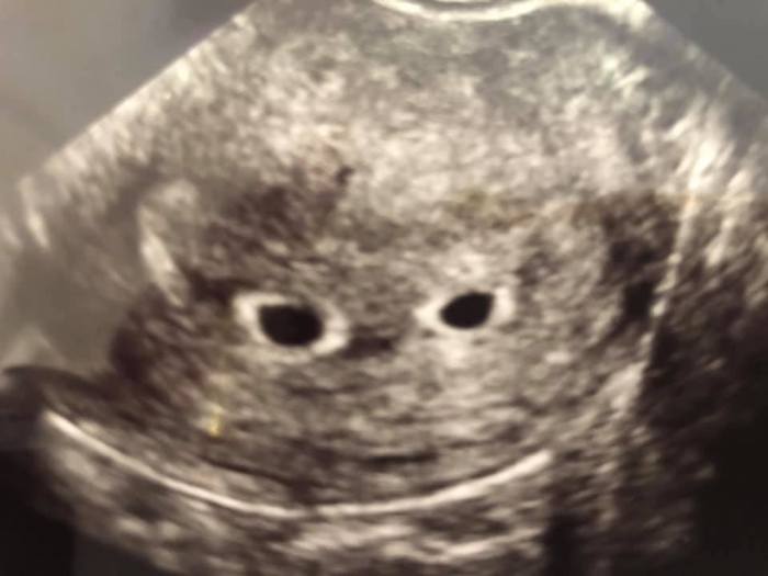 cholestasis of pregnancy twin ulrasound 5 weeks