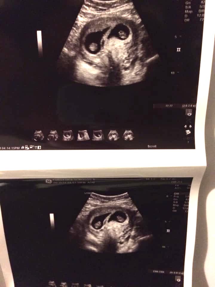 twins ultrasound 5 weeks