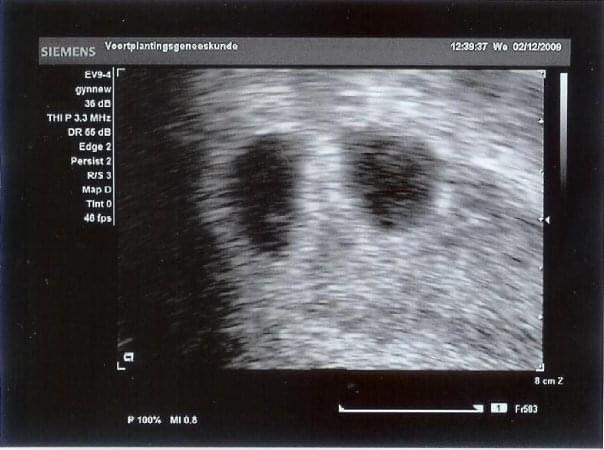 5 Weeks Pregnant with Twins