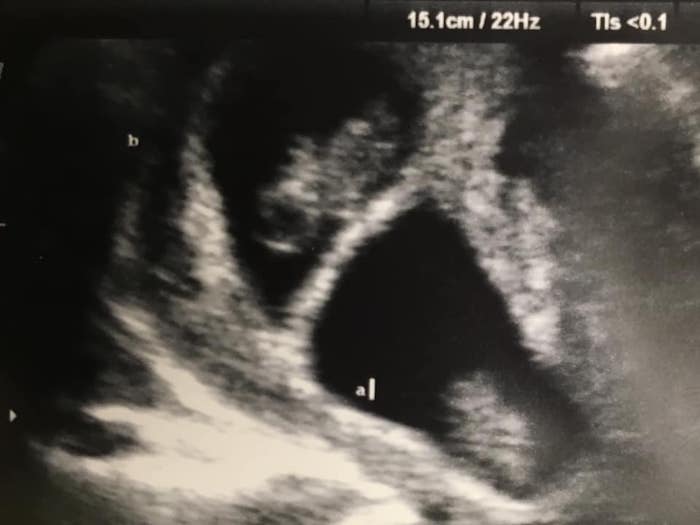 twin ultrasound 6 weeks