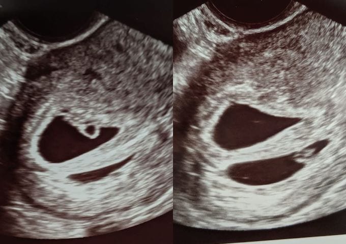 twin ultrasound 6 weeks