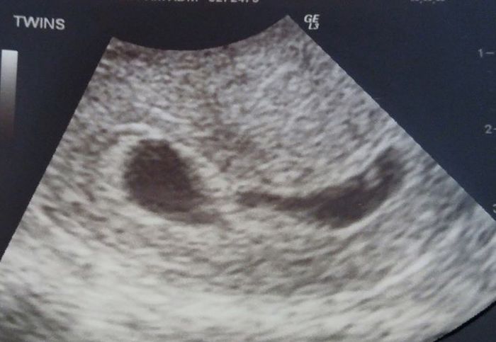 twin ultrasound 6 weeks