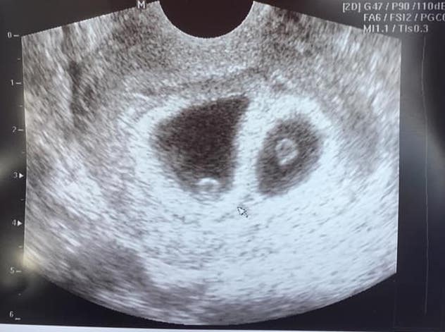 Early twin ultrasound at 6 weeks with twins