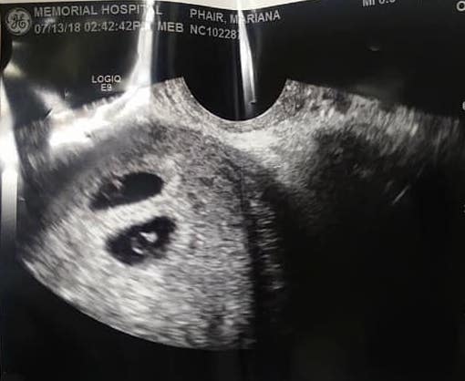 Early twin ultrasound at 6 weeks with twins