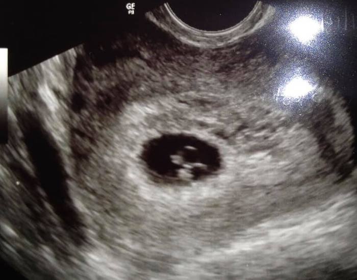 twin ultrasound 6 weeks