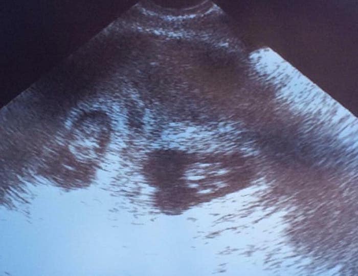 twin ultrasound 6 weeks