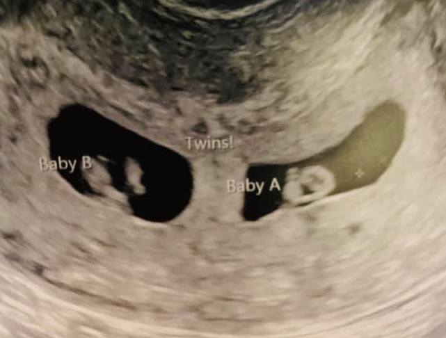 twin ultrasound 6 weeks