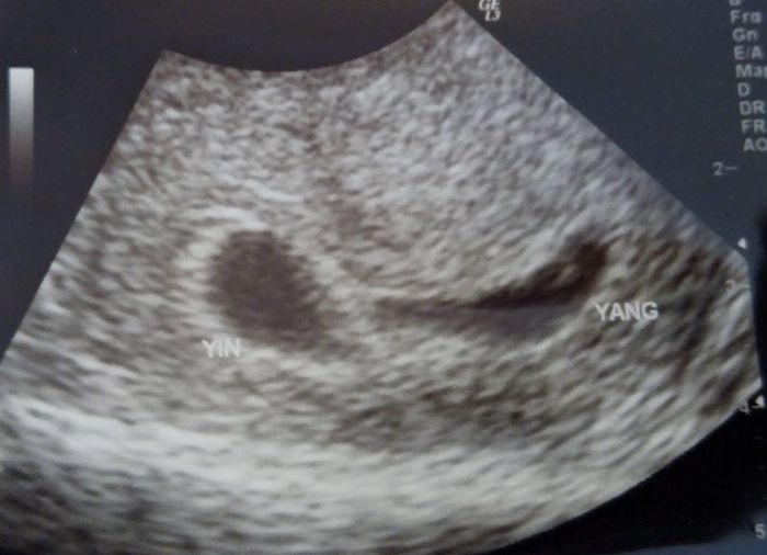 Early twin ultrasound at 6 weeks with twins