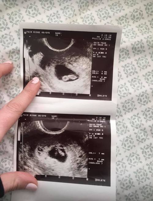 Early twin ultrasound at 6 weeks with twins