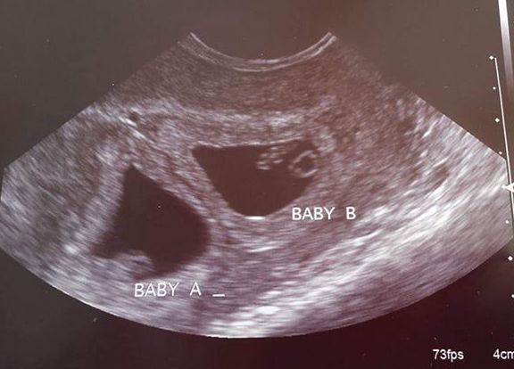 Early twin ultrasound at 6 weeks with twins