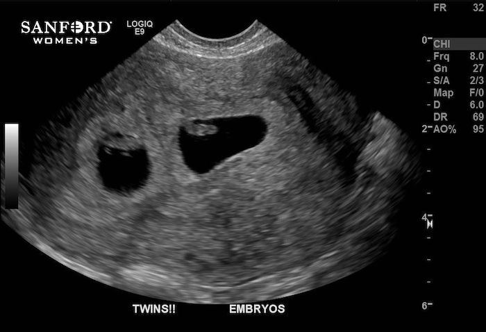 Twin Pregnancy Symptoms At 6 Weeks