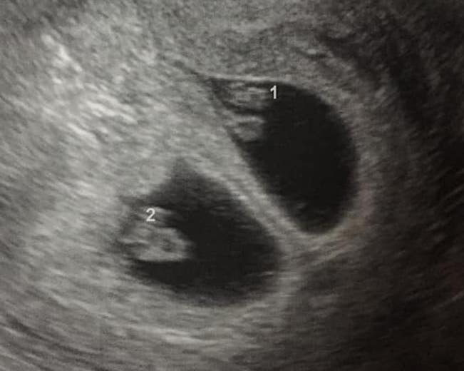 Early twin ultrasound at 6 weeks with twins